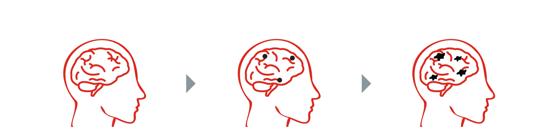 示意圖：大腦中的 β 類澱粉蛋白逐步聚集成斑塊
